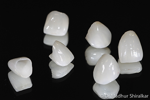 allporcelaincrowns1