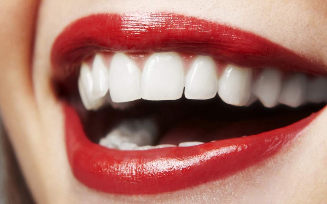 porcelain-veneers