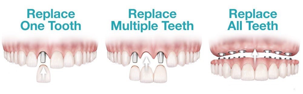 Professional Teeth Replacement In Melbourne