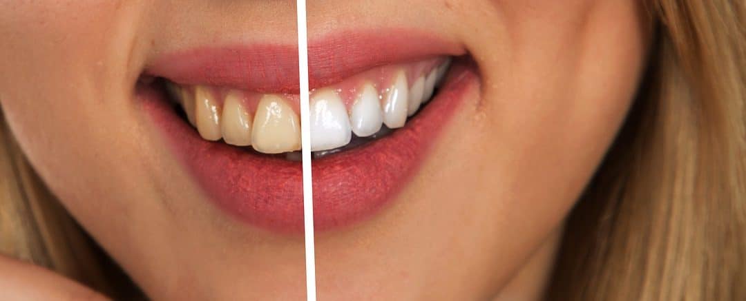 17 Struggles People With Bad Teeth Know To Be True