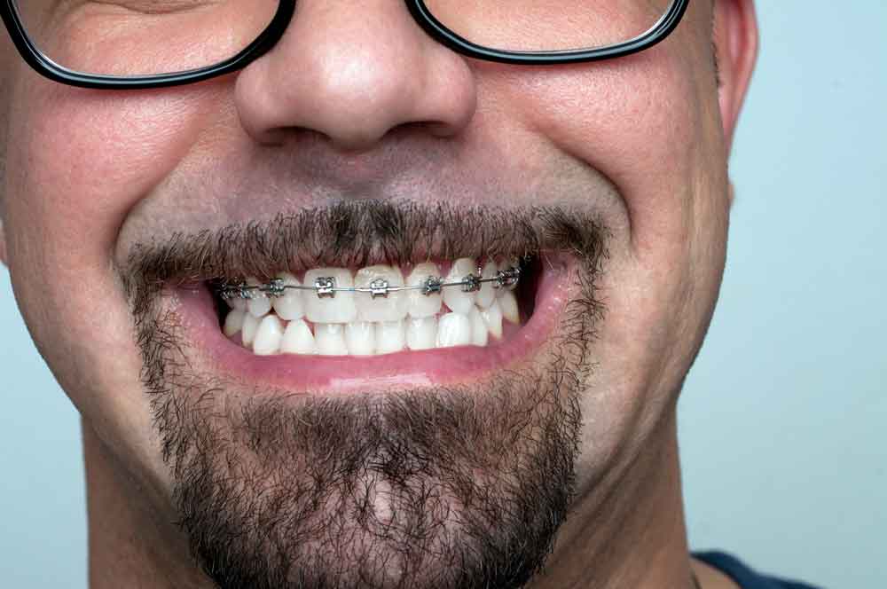 How much do braces cost