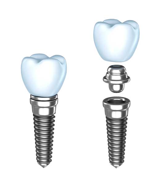 implant procedure