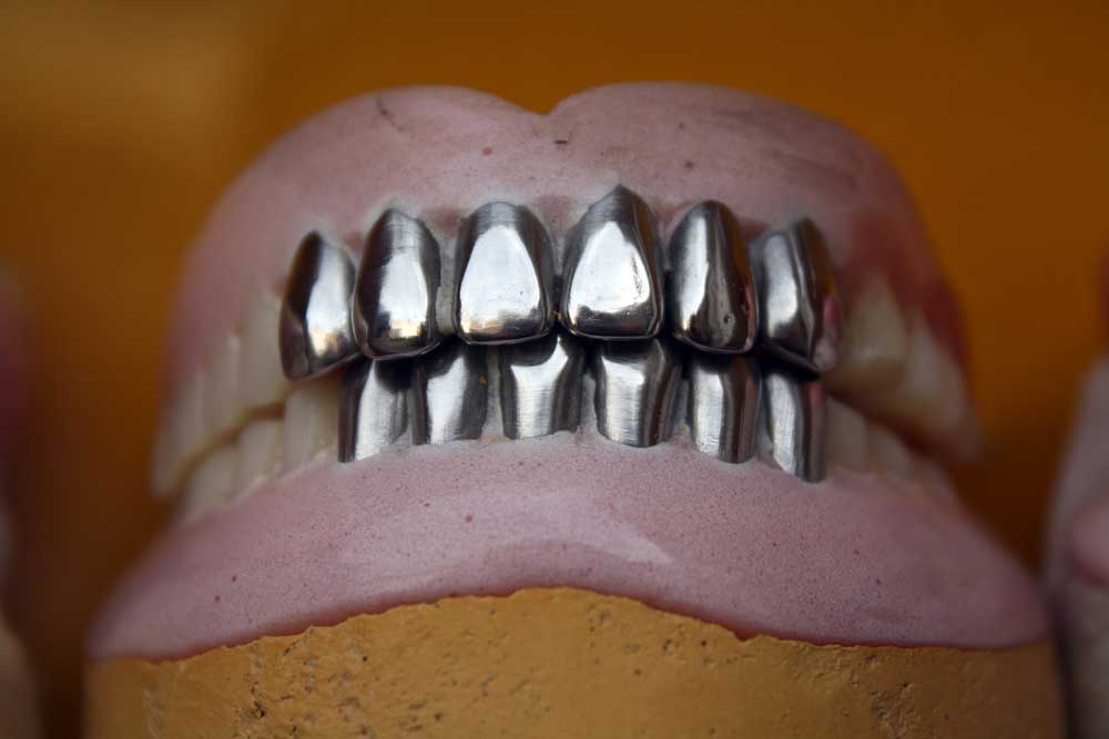 metal crowns