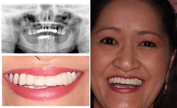 How To Properly Maintain All-On-4 Dental Implants Courtesy Of Prosmiles