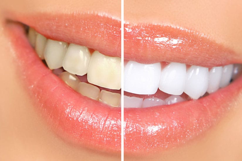 Why You Should Consider Porcelain Veneers To Enhance Your Smile