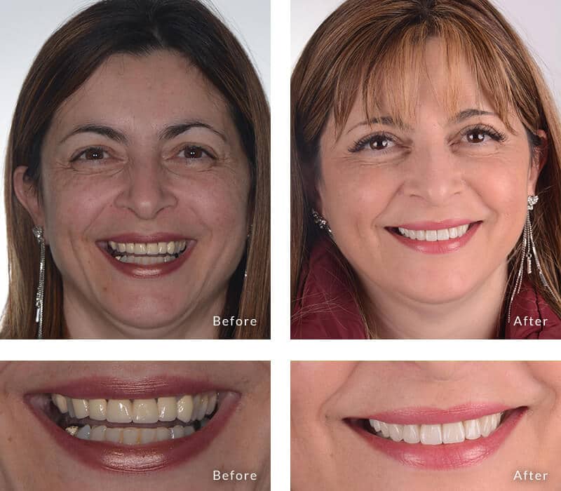 What is cosmetic dentistry?  Smile Makeover Northcote VIC