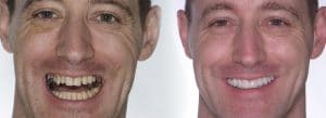 Dental-Implant-Faq-5