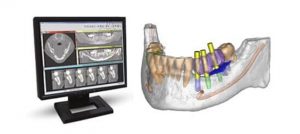 Full mouth x-ray & 3D CT scan
