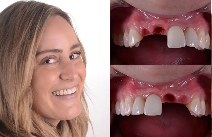 Multiple Dental Implants img Philosophy