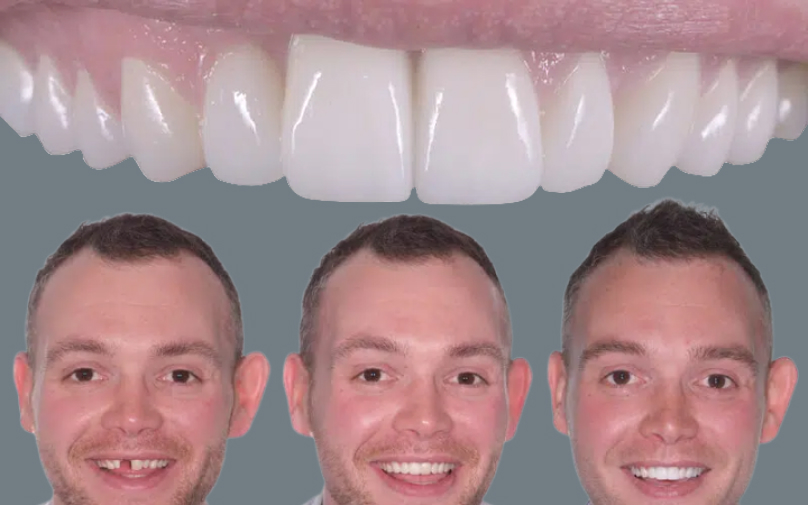 Single Dental Implant img Hidden Costs